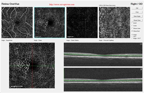 OCT angiography & macular telangiectasia