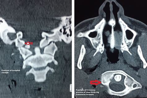 Ct Scan Of Neck Showing Fracture Of The Occipital Condyle And Fracture | The Best Porn Website