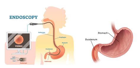 Duodenal Cancer: Risk Factors, Investigation, Sign and Symptoms