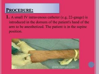 Bier block (intravenous regional anesthesia) | PPT