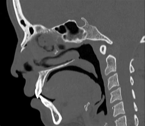 What is the Best Imaging Study to Evaluate a Broken Nose?