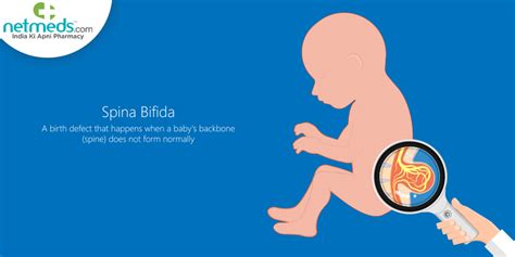 Spina Bifida: Causes, Diagnosis, Prevention And Treatment