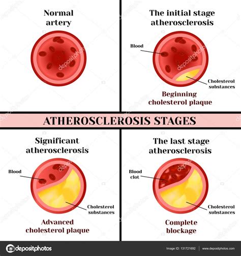 Atherosclerosis stages. Cholesterol plaques. — Stock Vector © mrs.bazilio.gmail.com #131721692