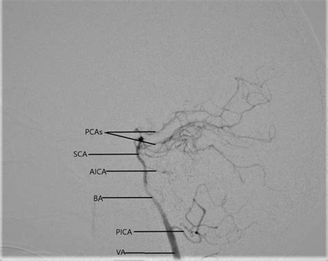 Neuroanatomy, Anterior Inferior Cerebellar Arteries - StatPearls - NCBI ...