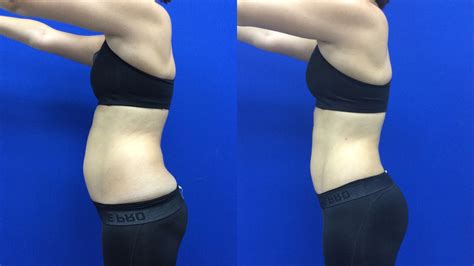 I Tried Laser Liposuction — Before and After Laser Liposuction Photos ...