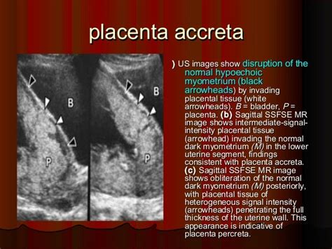 Placenta ultrasound