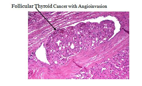 Follicular Thyroid Cancer Diagnosis