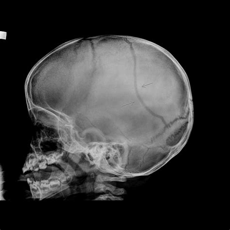 Radiografia Craneal