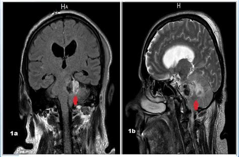 MRI showing left posterior fossa and cerebellpontine angle lesion... | Download Scientific Diagram