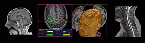 Neurological MRI - Zwanger-Pesiri Radiology