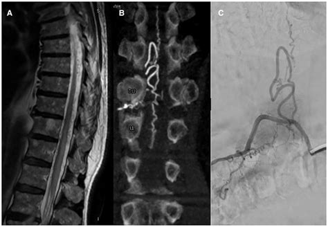 Frontiers Spinal Dural And Epidural Arteriovenous Fistula:, 53% OFF