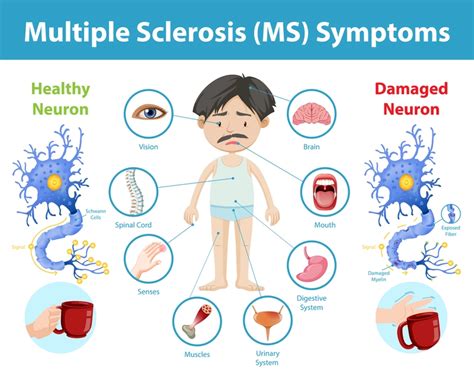 Unveiling Multiple Sclerosis (MS) - Cura4U