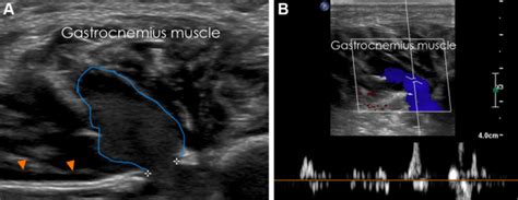 Peroneal Vein Ultrasound