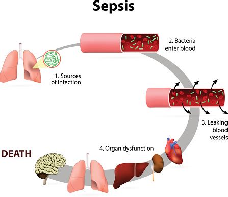 Sepsis, bacteremia and the risk of septic shock (life-threatening low ...