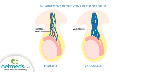 Varicocele: Causes, Symptoms And Treatment