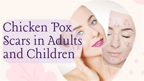 How to Remove Chicken Pox Scars in Adults Or Children