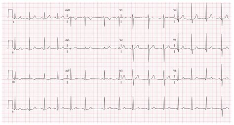 Normal Pediatric Ecg