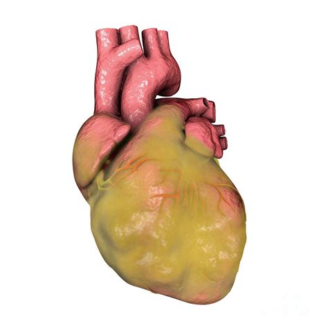 Fatty Heart Photograph by Kateryna Kon/science Photo Library - Pixels