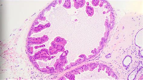 Apocrine Metaplasia Of Breast Usmle - slidesharetrick