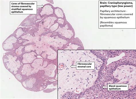 Craniopharyngioma Histology