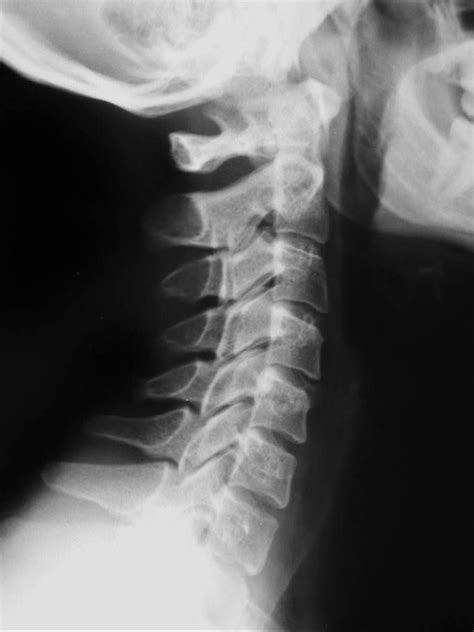 Radiografía de la columna cervical, perfil | Radiografia, Columnas