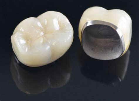 Porcelain fused metal crowns and dental implant cap at AMD