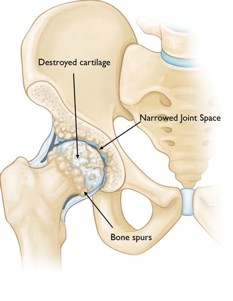 Osteoarthritis of the Hip - Orthopedic & Sports Medicine