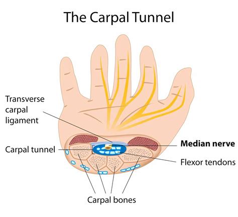 Explainer: what is carpal tunnel syndrome and what happens if I get it?