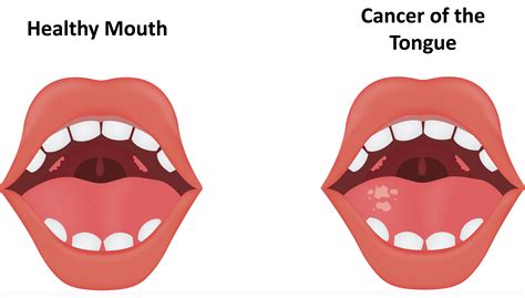 Tongue cancer