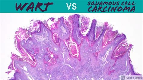 Wart vs Squamous Cell Carcinoma (Dermpath Pathology Dermatology Verruca Seborrheic Keratosis SCC ...