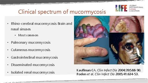 Mucormycosis Prof David W Denning Professor of Infectious