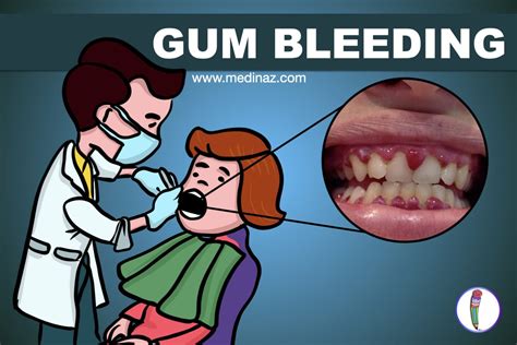 Gum Bleeding causes & Tips to Prevent - Medinaz Blog