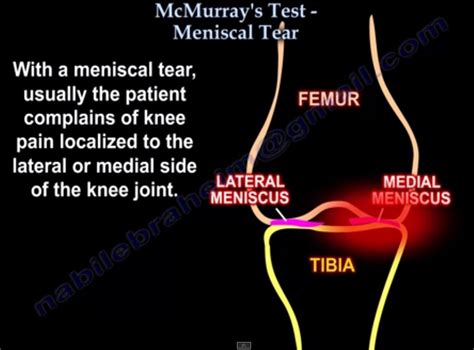 McMurray’s Test — OrthopaedicPrinciples.com