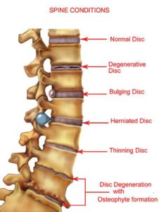 Slipped Disc | Delhi Pain Management Centre