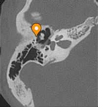 Scutum - e-Anatomy - IMAIOS