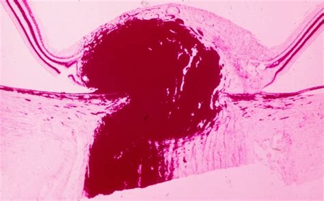 Optic Nerve Melanocytoma - Retina Image Bank