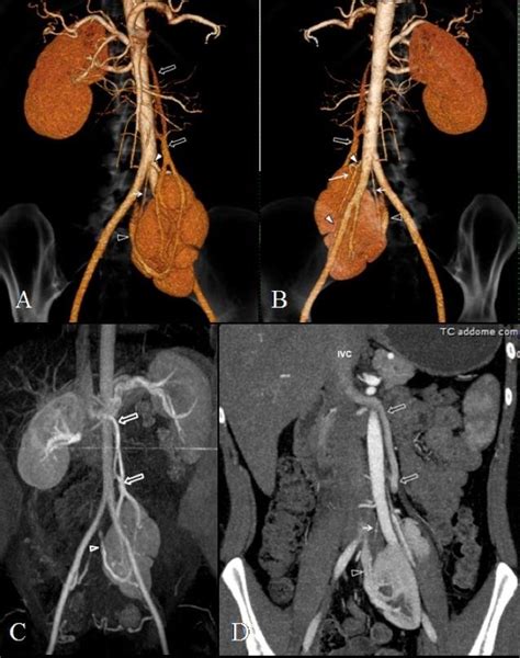 28-year-old woman with duplex collecting system in a pelvic kidney.... | Download Scientific Diagram