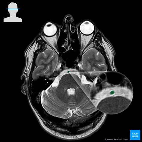 Basilar artery: Anatomy, course and branches | Kenhub