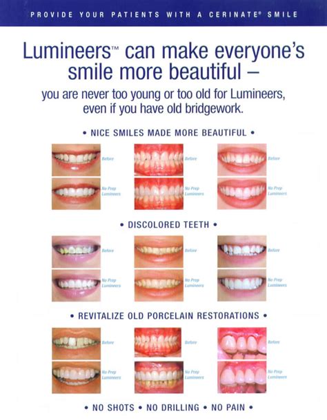 Lumineers World - save your teeth with us!: Before and After