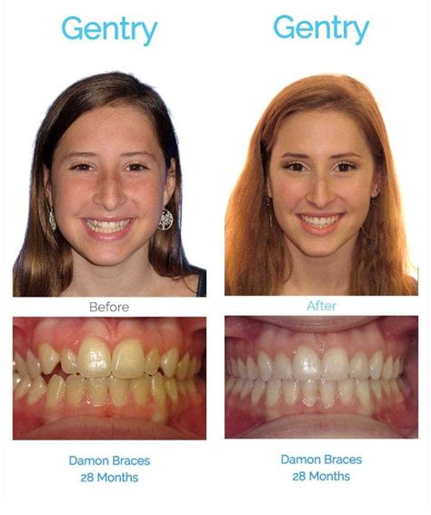 Ceramic Braces Before And After