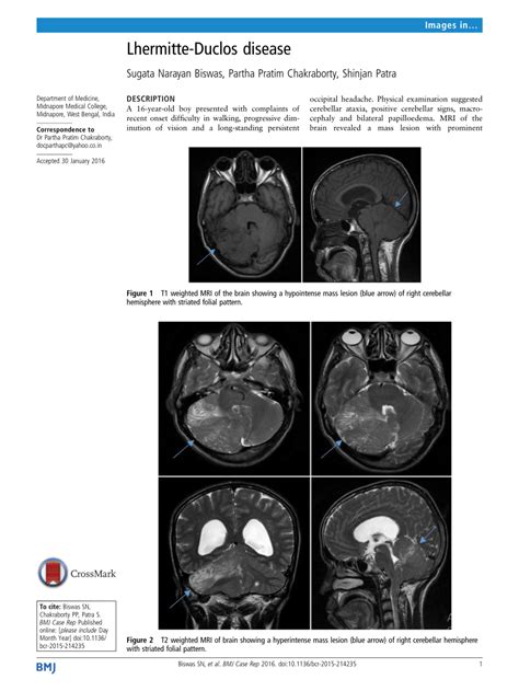 (PDF) Lhermitte-Duclos disease