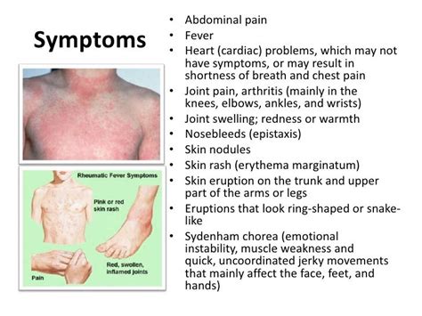 Rheumatic Fever Presentation