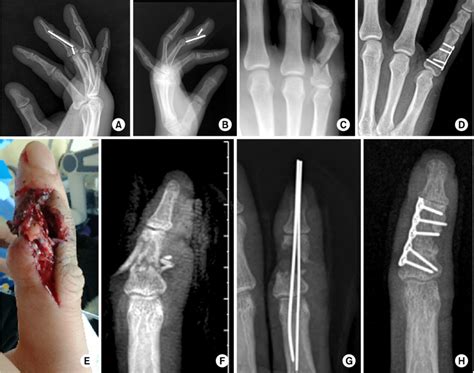 Middle Phalanx Fracture