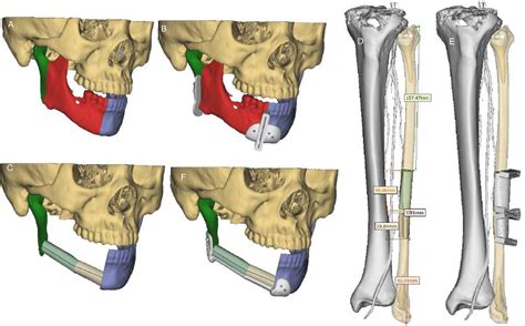 Figure 1 from Mandibular reconstruction with the vascularized fibula flap: comparison of virtual ...