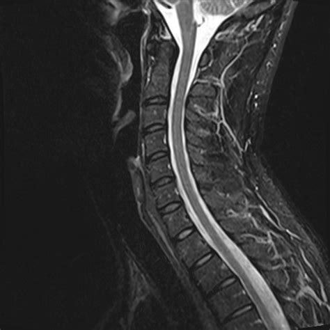 Normal cervical spine MRI | Radiology Case | Radiopaedia.org