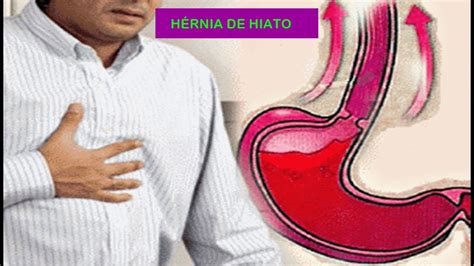 Hernia De Hiato O Que E Sintomas Diagnostico E Tratamento Tudo Sobre ...