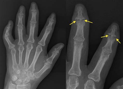 Psoriatic arthritis - DIP erosions - Radiology at St. Vincent's ...