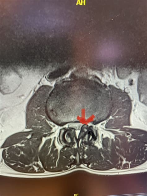 Lateral Recess Stenosis | NSPC Brain & Spine Surgery