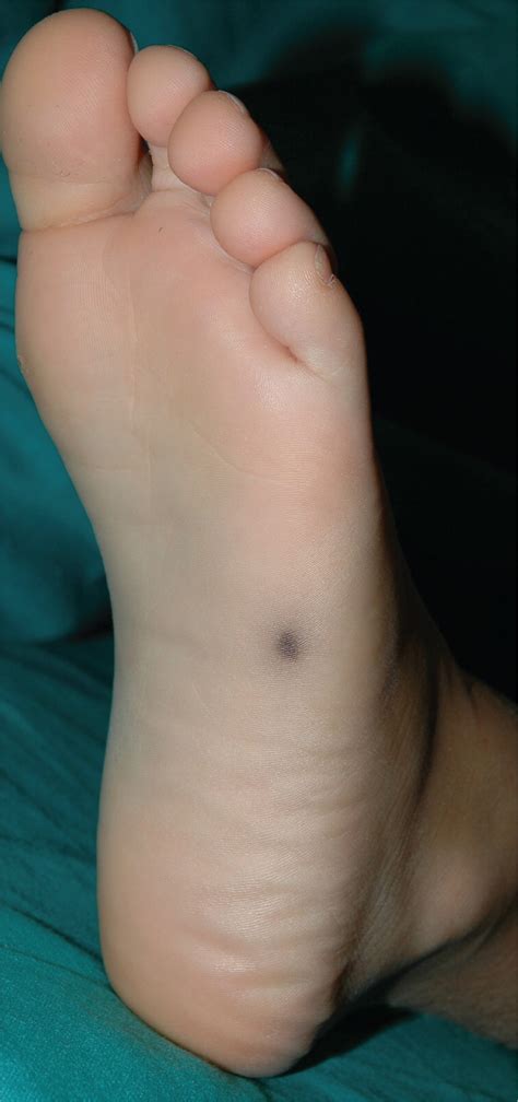 Pigmented Lesion on the Sole in a Child | AAFP