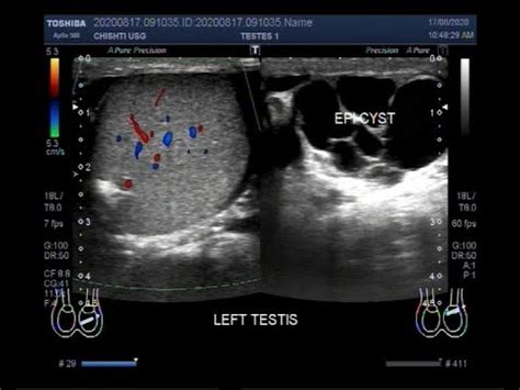 Testicular Cyst Ultrasound